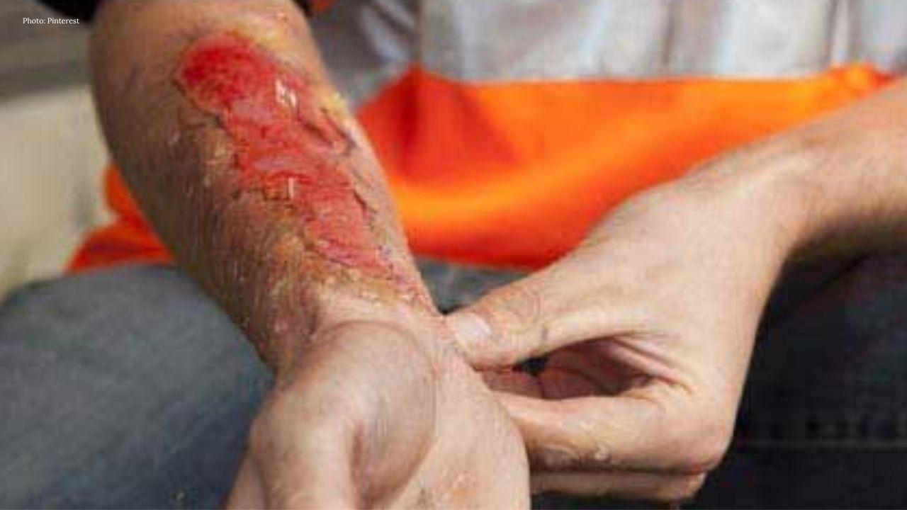 Indonesia officer quits after acid attack