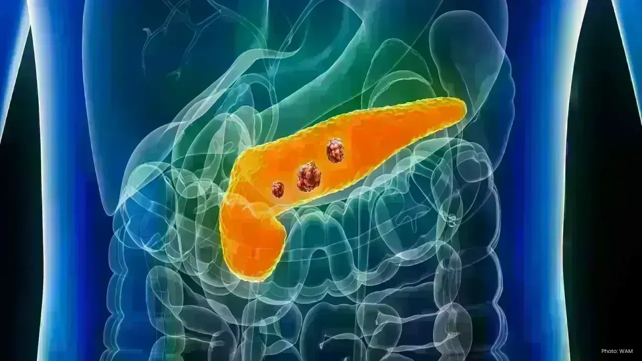 Revolutionary Oral Medication Offers New Hope in Pancreatic Cancer Treatment